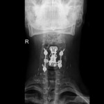 Sostituzione del corpo vertebrale di C5 con Cage-Plate e stabilizzazione posteriore per corpectomia in paziente con neoplasia benigna, ma destruente, del corpo di C5 (Rx antero-posteriore)