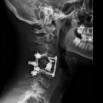 Sostituzione del corpo vertebrale di C5 con Cage-Plate e stabilizzazione posteriore per corpectomia in paziente con neoplasia benigna, ma destruente, del corpo di C5 (Rx laterale)