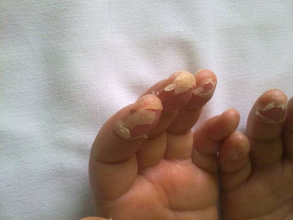 Sindrome di Kawasaki: esfoliazione dita; particolare dei polpastrelli