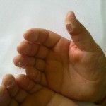 Sindrome di Kawasaki - esfoliazione dita