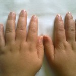 S. di Kawasaki: esfoliazione dita delle mani, la visione del dorso permette di evidenziare, meglio che nelle altre, un modesto edema