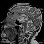 Meningioma cerebrale della doccia olfattoria - immagine RMN
