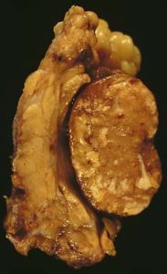 Macroscopic appearance of Warthin's tumor.