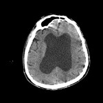 TC encefalo in paziente con marcata dilatazione dei ventricoli cerebrali
