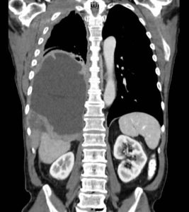 TC di mesotelioma pleurico (vasta massa che schiaccia il polmone destro) – tratto da Wikipedia.org