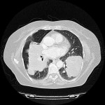 Grosse metastasi polmonari bilaterali di carcinoma mammario alla TC del torace