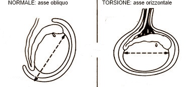 Asse del testicolo normale e in caso di torsione del funicolo spermatico