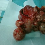 UTERO FIBROMATOSO: utero con multipli grossi fibromi sottosierosi ed intramurali (pezzo operatorio)